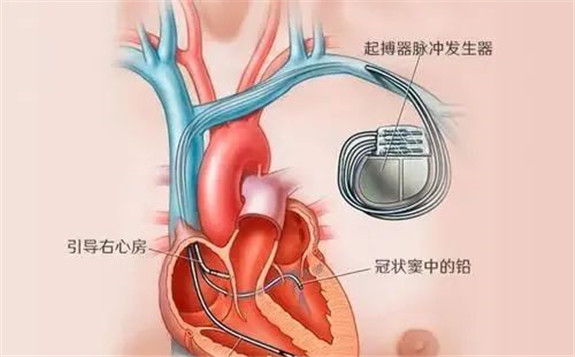 韓國研發太陽能充電心臟起搏器